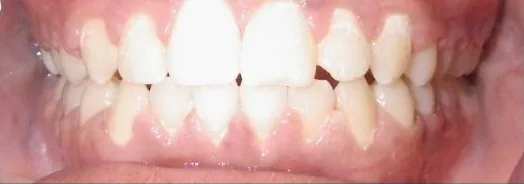 Crowded Teeth and Overbite treated with braces after orthodontic treatment at Elate Orthodontics, case 3760