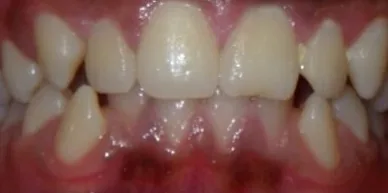 Crowded Teeth and Overbite treated with braces before orthodontic treatment at Elate Orthodontics, case 3760
