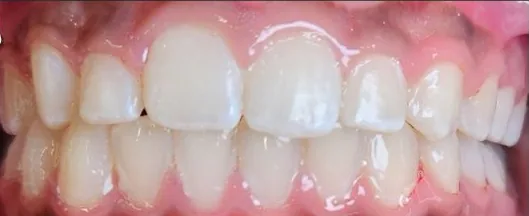 Crowded Teeth and Overbite treated with braces after orthodontic treatment at Elate Orthodontics, case 3772