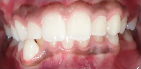 Crowded Teeth and Overbite treated with braces before orthodontic treatment at Elate Orthodontics, case 3772