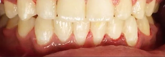 Crowded Teeth and Overbite treated with braces after orthodontic treatment at Elate Orthodontics, case 3780