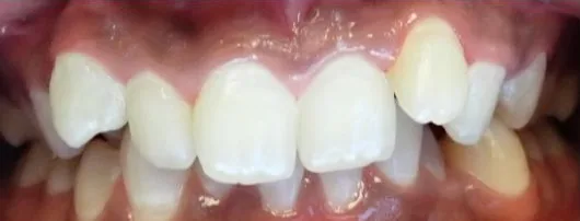 Crowded Teeth and Overbite treated with braces before orthodontic treatment at Elate Orthodontics, case 3780