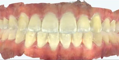 Crowded Teeth and Overbite treated with braces after orthodontic treatment at Elate Orthodontics, case 3784