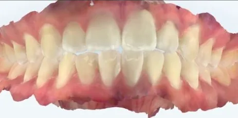 Crowded Teeth and Overbite treated with braces before orthodontic treatment at Elate Orthodontics, case 3784
