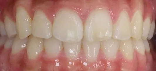 Crowded Teeth and Overbite treated with clear aligners after orthodontic treatment at Elate Orthodontics, case 3796