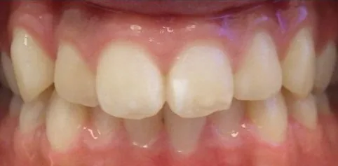 Crowded Teeth and Overbite treated with clear aligners before orthodontic treatment at Elate Orthodontics, case 3796