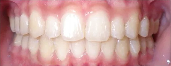 Crowded Teeth and Overbite treated with clear aligners after orthodontic treatment at Elate Orthodontics, case 3826