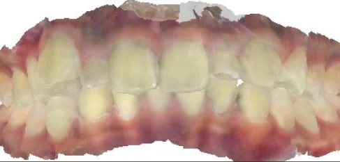 Crowded Teeth and Overbite treated with clear aligners before orthodontic treatment at Elate Orthodontics, case 3826