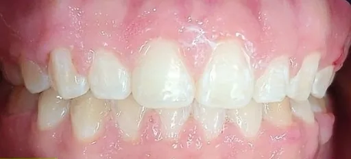 Crowded Teeth and Overbite treated with braces after orthodontic treatment at Elate Orthodontics, case 3838