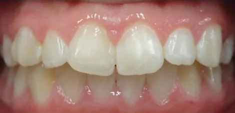 Crowded Teeth and Overbite treated with braces before orthodontic treatment at Elate Orthodontics, case 3838