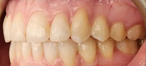 Crowded Teeth and Overbite treated with clear aligners after orthodontic treatment at Elate Orthodontics, case 3860