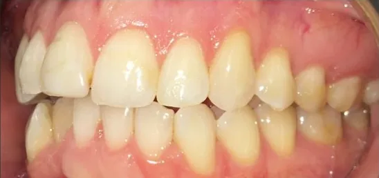 Crowded Teeth and Overbite treated with clear aligners before orthodontic treatment at Elate Orthodontics, case 3860