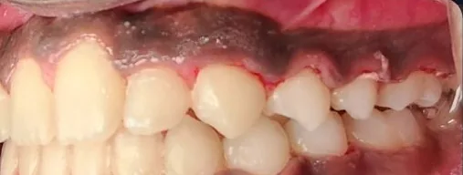 Crowded Teeth and Overbite treated with braces after orthodontic treatment at Elate Orthodontics, case 3888