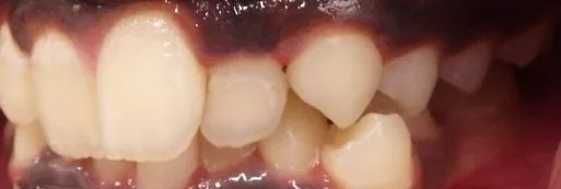 Crowded Teeth and Overbite treated with braces before orthodontic treatment at Elate Orthodontics, case 3888