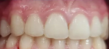 Crowded Teeth and Overbite treated with braces after orthodontic treatment at Elate Orthodontics, case 3892