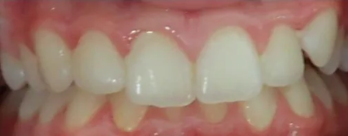 Crowded Teeth and Overbite treated with braces before orthodontic treatment at Elate Orthodontics, case 3892