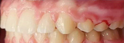 Crowded Teeth, Overbite and Narrow Palate treated with braces after orthodontic treatment at Elate Orthodontics, case 3896