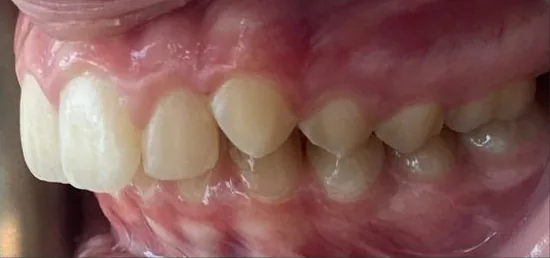 Crowded Teeth, Overbite and Narrow Palate treated with braces before orthodontic treatment at Elate Orthodontics, case 3896