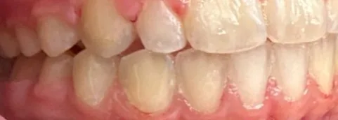 Crowded Teeth and Overbite treated with braces after orthodontic treatment at Elate Orthodontics, case 3900