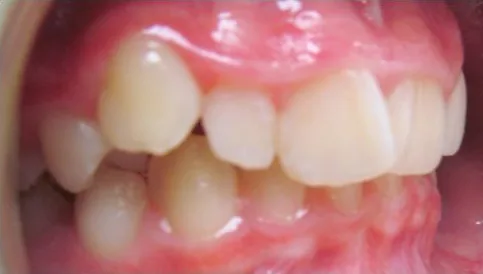 Crowded Teeth and Overbite treated with braces before orthodontic treatment at Elate Orthodontics, case 3900