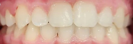 Crowded Teeth and Overbite treated with braces after orthodontic treatment at Elate Orthodontics, case 3908