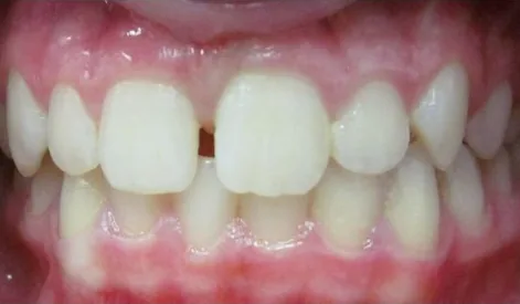 Crowded Teeth and Overbite treated with braces before orthodontic treatment at Elate Orthodontics, case 3908