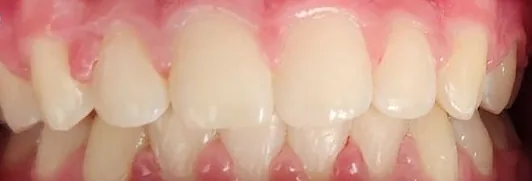 Crowded Teeth and Overbite treated with braces after orthodontic treatment at Elate Orthodontics, case 3932