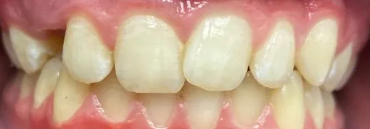 Crowded Teeth and Overbite treated with braces before orthodontic treatment at Elate Orthodontics, case 3932