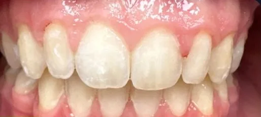 Crowded Teeth and Overbite treated with braces after orthodontic treatment at Elate Orthodontics, case 3940