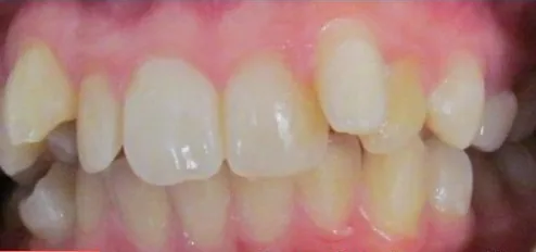 Crowded Teeth and Overbite treated with braces before orthodontic treatment at Elate Orthodontics, case 3940