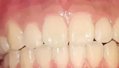 Crowded Teeth, Overbite and Overjet treated with braces after orthodontic treatment at Elate Orthodontics, case 3948