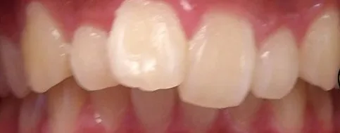 Crowded Teeth, Overbite and Overjet treated with braces before orthodontic treatment at Elate Orthodontics, case 3948