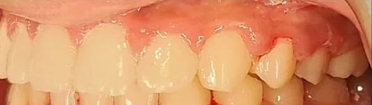Crowded Teeth, Overbite and Narrow Palate treated with braces after orthodontic treatment at Elate Orthodontics, case 3990
