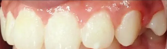 Crowded Teeth, Overbite and Narrow Palate treated with braces before orthodontic treatment at Elate Orthodontics, case 3990