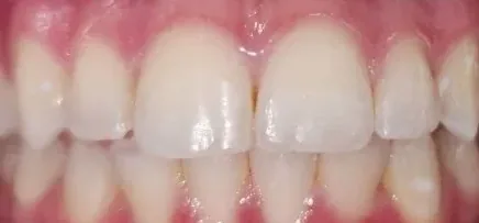 Crowded Teeth, Overbite and Overjet treated with clear aligners after orthodontic treatment at Elate Orthodontics, case 4022