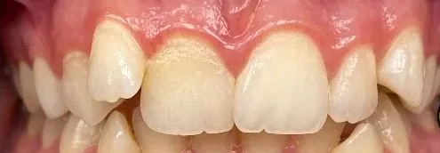Crowded Teeth, Overbite and Overjet treated with clear aligners before orthodontic treatment at Elate Orthodontics, case 4022