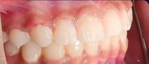 Crowded Teeth, Overbite and Overjet treated with braces after orthodontic treatment at Elate Orthodontics, case 4036