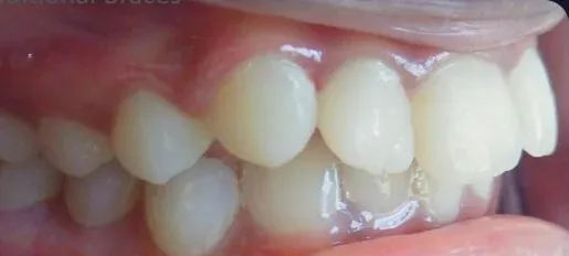 Crowded Teeth, Overbite and Overjet treated with braces before orthodontic treatment at Elate Orthodontics, case 4036