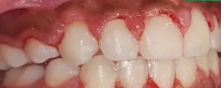 Crowded Teeth, Overbite and Overjet treated with braces after orthodontic treatment at Elate Orthodontics, case 4050