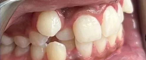 Crowded Teeth, Overbite and Overjet treated with braces before orthodontic treatment at Elate Orthodontics, case 4050