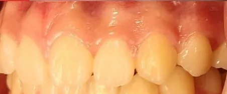 Crowded Teeth and Overbite treated with clear aligners after orthodontic treatment at Elate Orthodontics, case 4058