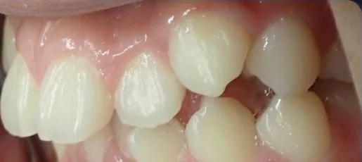 Crowded Teeth and Overbite treated with clear aligners before orthodontic treatment at Elate Orthodontics, case 4058