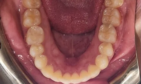 Crowded Teeth and Overbite treated with braces after orthodontic treatment at Elate Orthodontics, case 4062