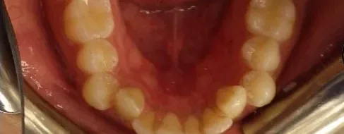 Crowded Teeth and Overbite treated with braces before orthodontic treatment at Elate Orthodontics, case 4062