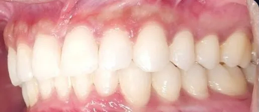 Crowded Teeth and Overbite treated with clear aligners after orthodontic treatment at Elate Orthodontics, case 4066