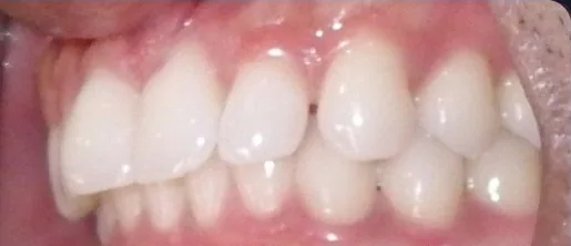 Crowded Teeth and Overbite treated with clear aligners before orthodontic treatment at Elate Orthodontics, case 4066