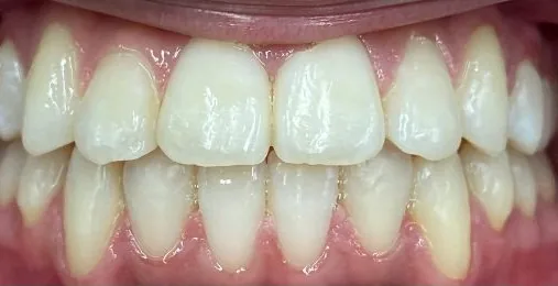 Crowded Teeth and Overjet treated with braces after orthodontic treatment at Elate Orthodontics, case 3578