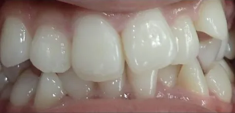 Crowded Teeth and Overjet treated with braces before orthodontic treatment at Elate Orthodontics, case 3578