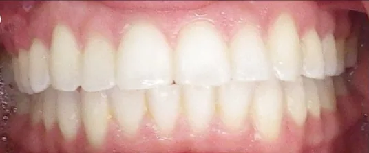 Crowded Teeth and Overjet treated with braces after orthodontic treatment at Elate Orthodontics, case 3582