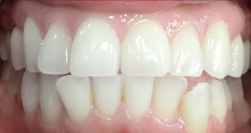 Crowded Teeth and Overjet treated with braces before orthodontic treatment at Elate Orthodontics, case 3582